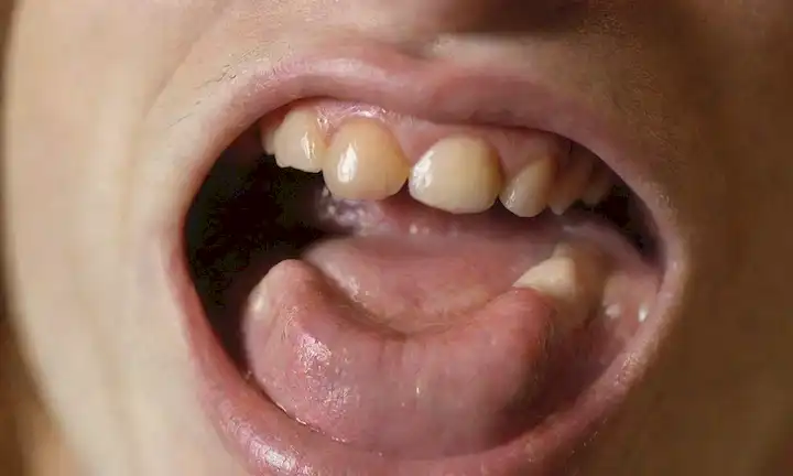 Una foto de cerca de una boca de perros con encías inflamadas, enrojecimiento y zonas hinchadas; posiblemente con bolsillos llenos de pus amarillos o blancos; una lengua pegando hacia fuera; dientes parcialmente visibles; un fondo borroso para centrar la atención en los detalles de cavidad oral